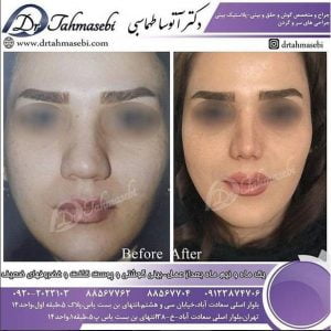 جراحی بینی گوشتی
