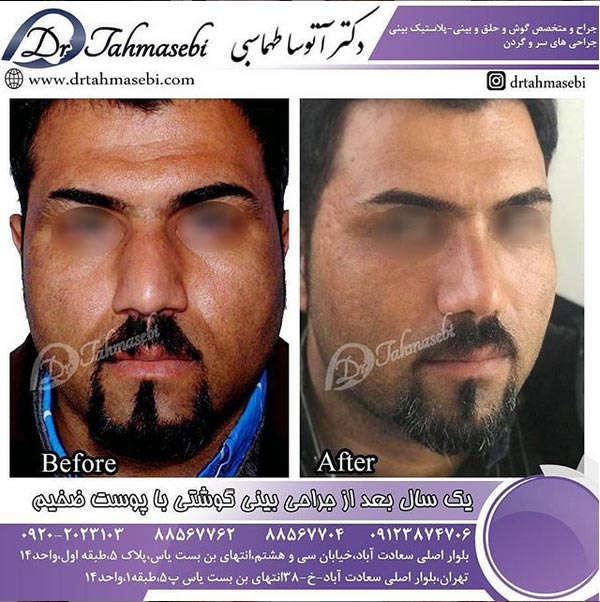 جراح بینی گوشتی در تهران
