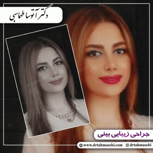 جراحی بینی نیمه فانتزی
