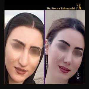 مراقبت های بعد از جراحی بینی - دکتر آتوسا طهماسبی در خرم آباد