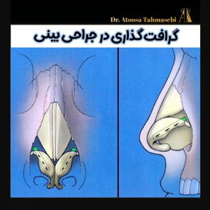 گرافت گذاری در جراحی بینی - دکتر آتوسا طهماسبی