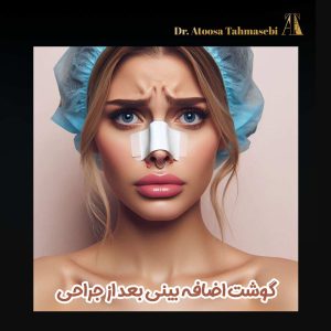 گوشت اضافه بعد از عمل بینی - دکتر آتوسا طهماسبی