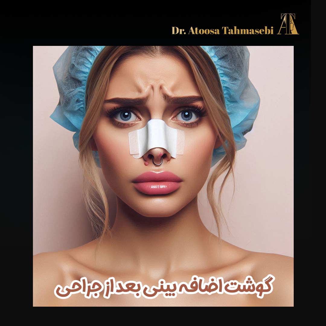 گوشت اضافه بعد از عمل بینی - دکتر آتوسا طهماسبی