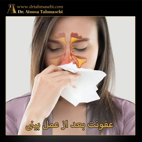 عفونت بعد از عمل بینی - دکتر طهماسبی