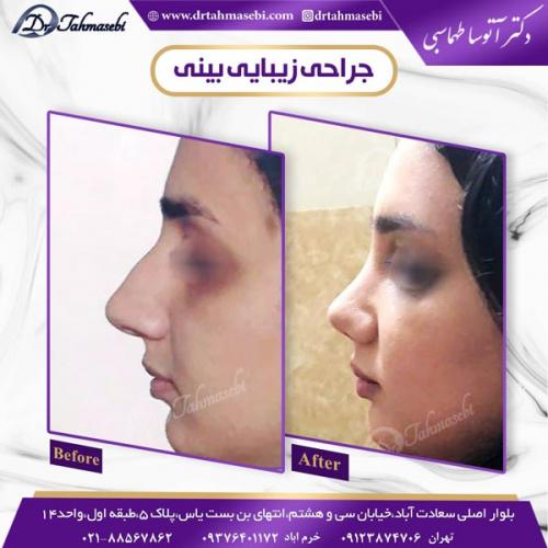 جراحی بینی 105