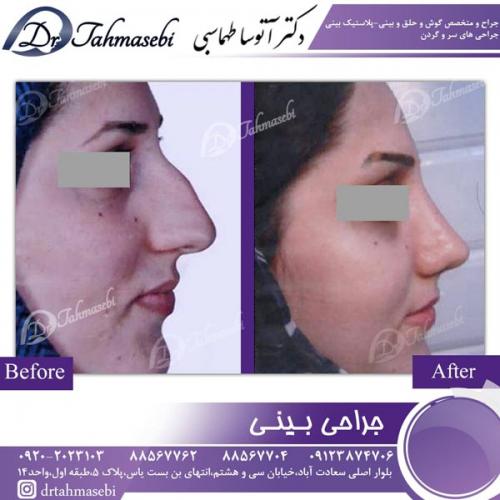 جراحی بینی 78